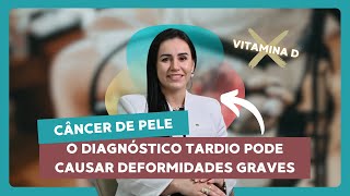 ⚠️ Câncer de pele: o diagnóstico tardio pode causar deformidades graves