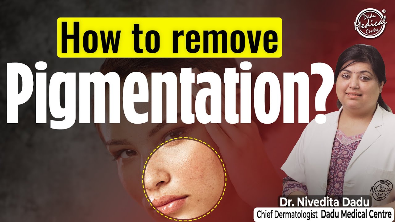 Types of Pigmentation on Face | How to Remove Pigmentation? | Dermatology Treatment for Pigmentation
