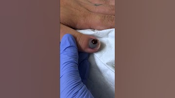 Trephination of a Fingernail Subungual Hematoma with Cautery