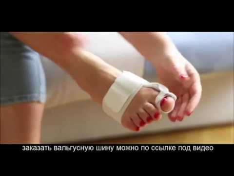 Вальгусная Деформация (Hallux Valgus): Период После Удаления Косточки На Ноге