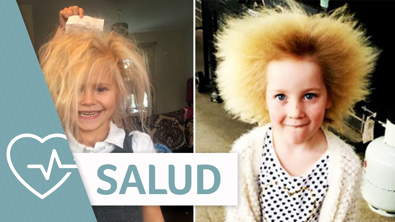 El síndrome del cabello imposible de peinar: estas niñas lo sufren | Salud | Telemundo Lifestyle video phone beyonce mp3