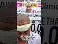 گنجے پن کا مکمل خاتمہ! 🌟 Best Hair Transplant in Karachi - Al-Khaleej Clinics
