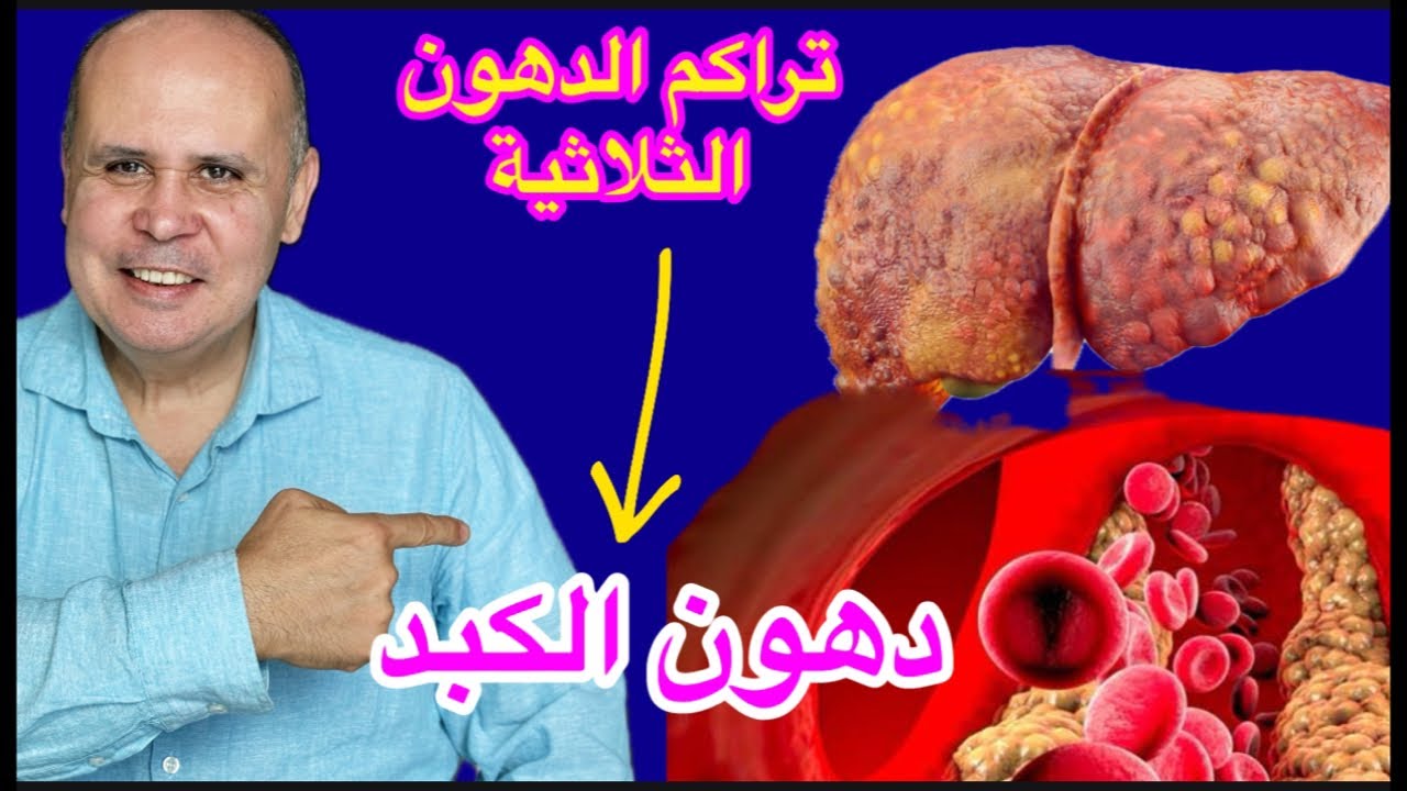 Хорошие новости без лекарств: 9 способов лечения триглицеридов, жировой дистрофии печени и сжиган...