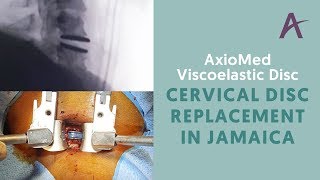 AxioMed Cervical Disc Replacement in Jamaica by Orthopedic Surgeon Dr. Kingsley R. Chin