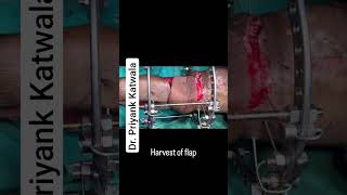 Complex lower limb defect Reconstruction done by flap by: Dr. Priyank Katwala #plasticsurgery #flaps