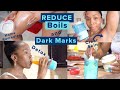 How to Get Rid of Boils, Dark Marks & Hidradenitis Suppurativa | Detox, Cleanse, & Sore Skin Care