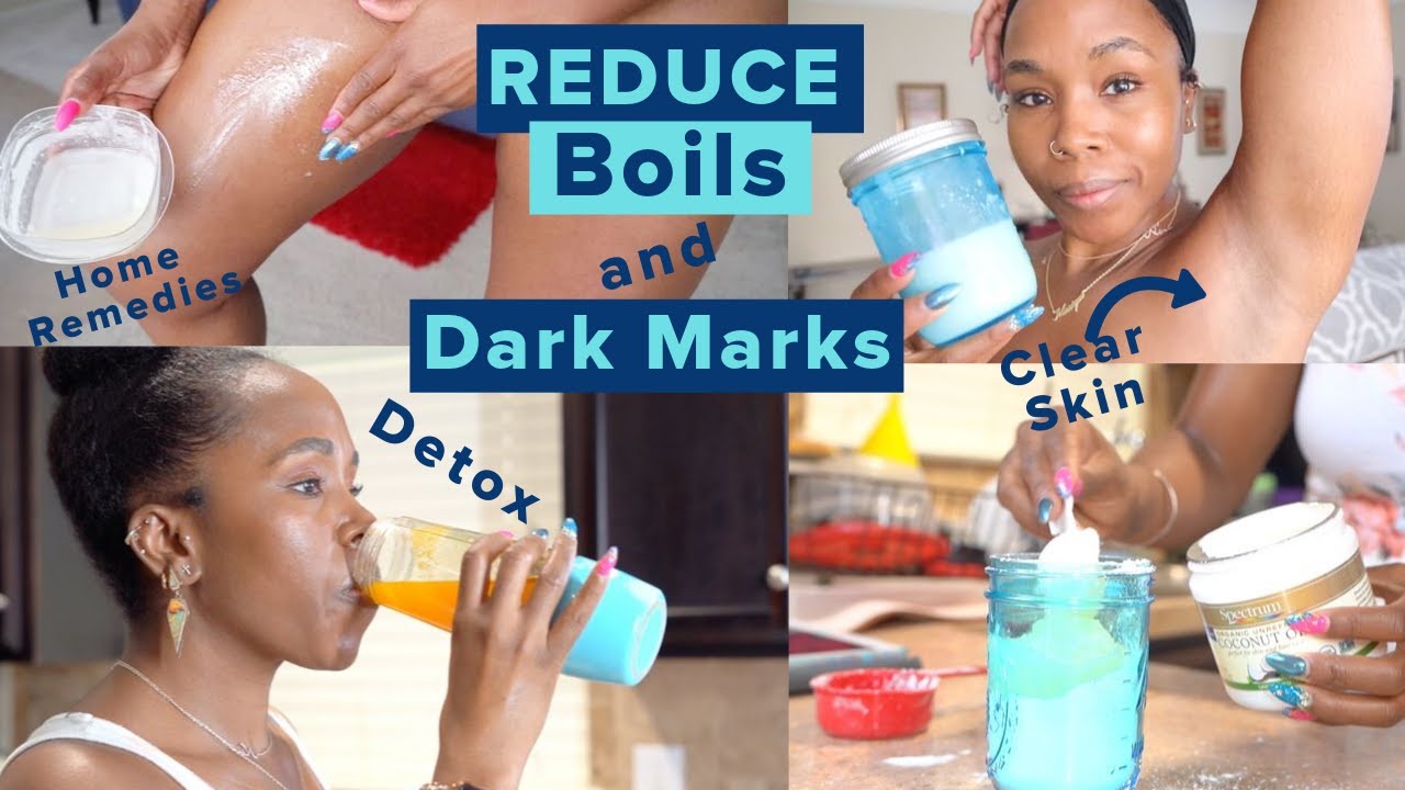 4baby How to Get Rid of Boils, Dark Marks & Hidradenitis Suppurativa | Detox, Cleanse, & Sore Skin Care