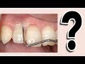 Why Treat Gum Disease?