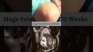 Baby Turning in Mothers Womb ? Fetal Movement, shorts