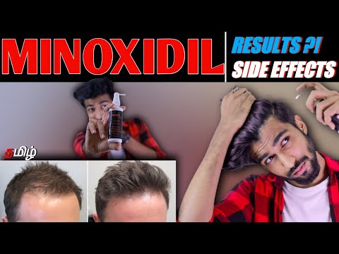 MINOXIDIL - KNOW EVERYTHING ABOUT MINOXIDIL | HAIR-GROWTH , SIDE EFFECTS | TAMIL