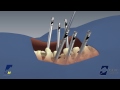 EVEREST® Minimally Invasive XT Spinal System Product Animation