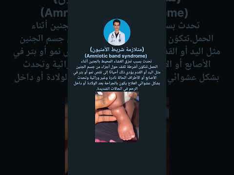 متلازمة شريط الأمنيون    دكتور سيرجن طب