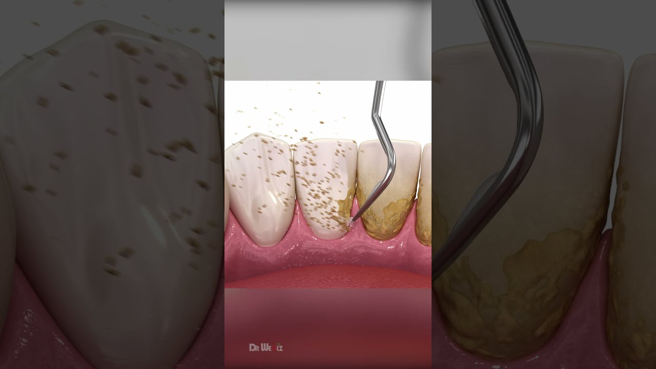 Scaling And Root Planing Therapy AMSR