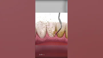 Scaling And Root Planing Therapy AMSR 