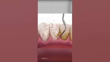 Thumbnail of Scaling and Root Planing Therapy: AMSR