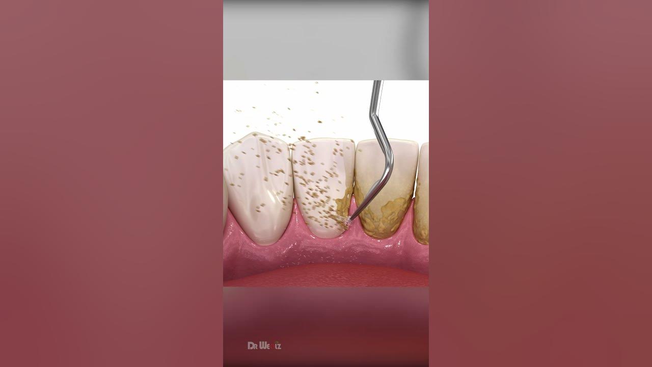 Scaling and Root Planing Therapy: AMSR Scaling and Root Planing Therapy: AMSR