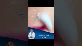 إزالة الشعر بدون ألم،متاح للشفاه أو تحت الإبط أو الجسم الكامل،مناسبة للبشرة الحساسة