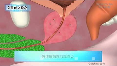 前立腺炎／ミルメディカル　家庭の医学 動画版