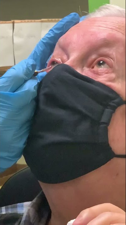 Optometrist Treats Dry Eye and Removes “Eye Plaque”