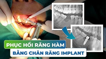 Để Mất Răng Lâu Có Tác Hại Gì? Phương Pháp Phục Hồi Răng Hàm Đã Mất Lâu Năm.