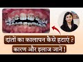 Daanton Ka Kalapan Kaise Hatayein? 🦷 Black Stains Removal | Causes, Treatment &amp; Home Care Tips