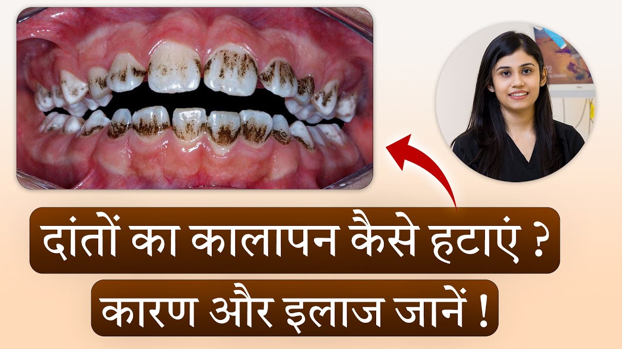 Daanton Ka Kalapan Kaise Hatayein? 🦷 Black Stains Removal | Causes ...