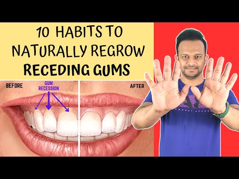 Video: Kaip išvengti atsitraukiančių dantenų: 10 žingsnių (su nuotraukomis)