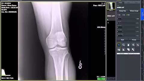 DRive V05 2 View Knee Workflow