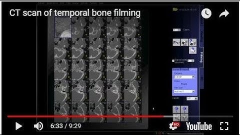CT scan of temporal bone filming