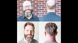 Men’s hair replacement