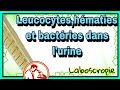 Leucocytes hmaties et bactrie dans lurine