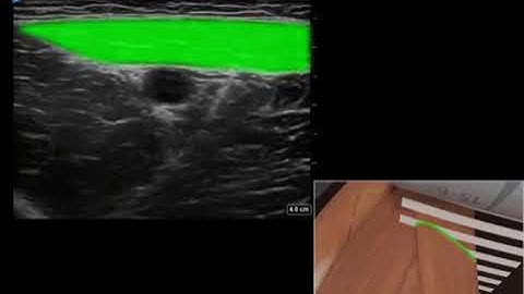 How To: ADDUCTOR CANAL BLOCK 3D Video