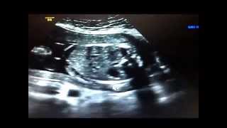 SSW 11 bis 25 Ultraschalluntersuchung Schwanger Baby + 3D 4D Bilder am Schluss