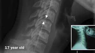 X-rays show Neck damage from Sitting