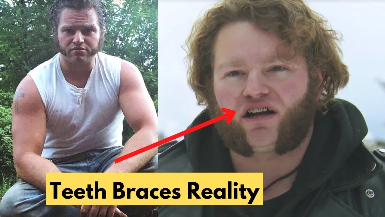 The Real Truth About Gabe Brown Braces. - YouTube