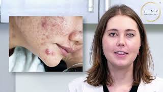 What are the different types of acne?