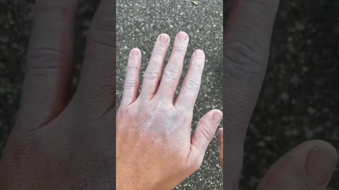 Frost bite - how to treat it 