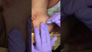 Electrolysis after Laser on the face - how more hair was created from laser