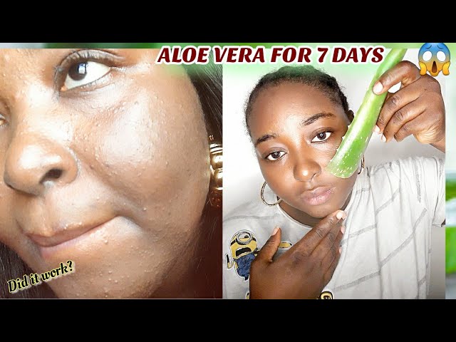 This is what Fresh Aloe Vera for 7 days did to my face . |Acne and Dark  spots