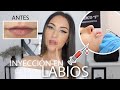 ME INYECTÉ LOS LABIOS💉 MI EXPERIENCIA CON EL ÁCIDO HIALURÓNICO ¿ME GUSTO?