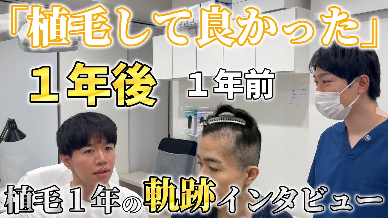 「ストレスが減った」植毛手術1年で前髪が割れない喜び｜既存毛の間へ1500株を移植した患者様の本音