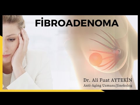 Göğüslerdeki Fibroadenoma
