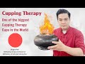 One of the biggest Cupping Therapy Cup in the World