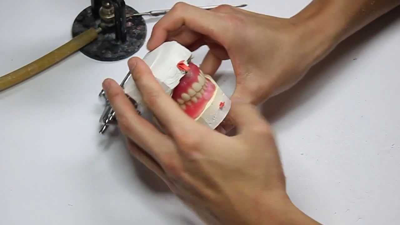 Dentures Teeth Set Up in Wax - YouTube