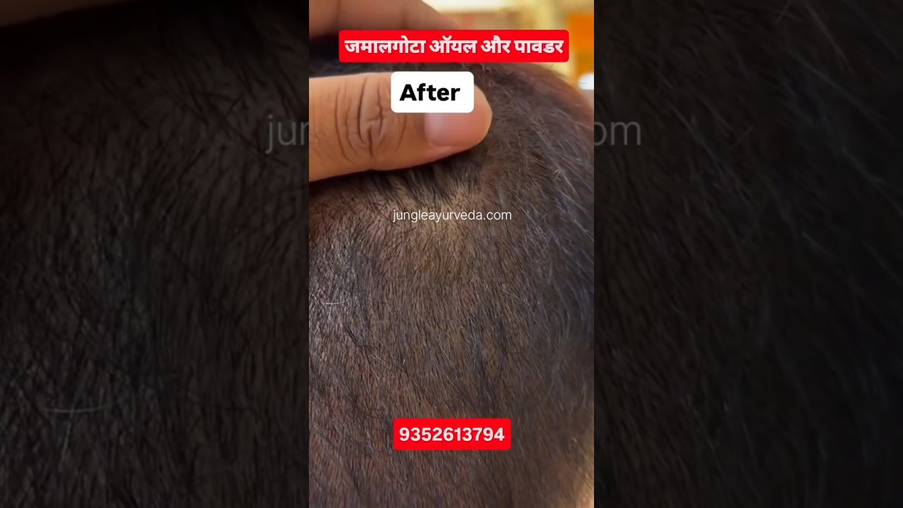 jamalgota hair oil, croton tiglium hair benefits 