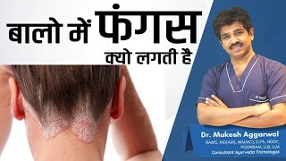 Cause & Treatment of Fungal Infection in Hair | Dr Mukesh Aggarwal