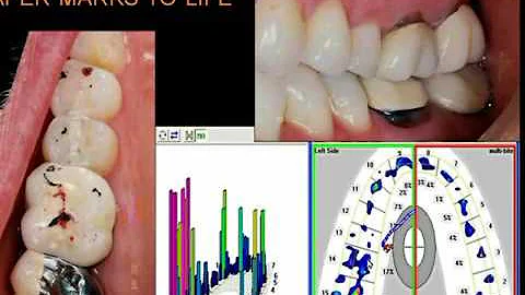 Dental Occlusion & Paper Marks with Dr. Robert Ker...