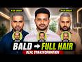 Hair Transplant in Delhi (HX-OPIJ) | Best Results & Cost of Hair Transplant in Delhi