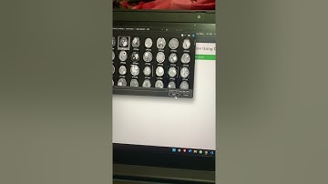 BRAIN TUMOR DETECTION USING DEEP LEARNING