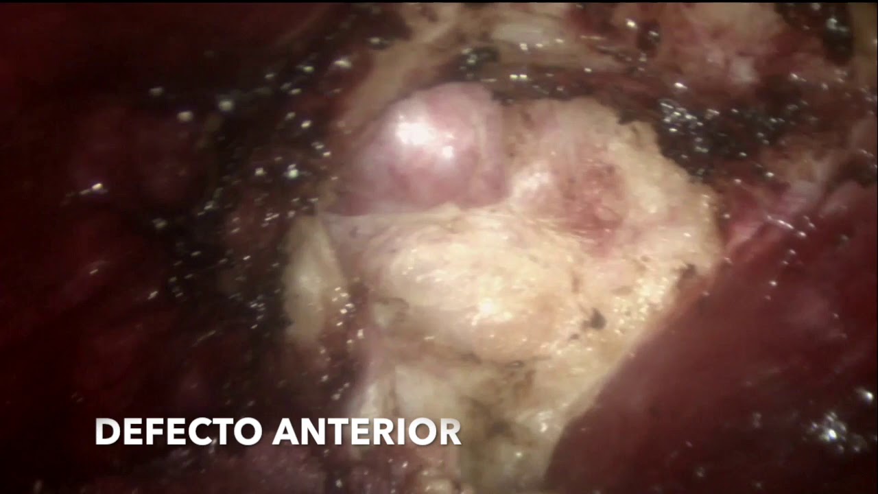 etep Rives Stoppa por hernia umbilical recidivada camera iphone 8 plus apk